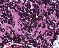 MEDULLOB BLASTOMA Histology Cellular, small cells, scant