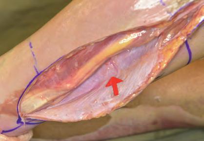 flap, posterior border of fibula (red