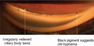 Preoperatively an indentation gonioscopy is needed as there could be a compromised angle contraindicating an anterior chamber IOL (in case the lens is removed intra capsularly).