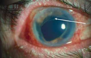 This increases the out flow resistance and the IOP rises with even a few cells. Penetrating Trauma Penetrating trauma causes the anterior chamber to stay shallow in the setting of an inflamed eye.