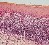 l hyperparakeratosis or hyperorthokeratosis; l liquefaction degeneration of the basal cell layer; l epithelial atrophy; l a dense subepithelial band of predominantly T lymphocytes; l elongated,