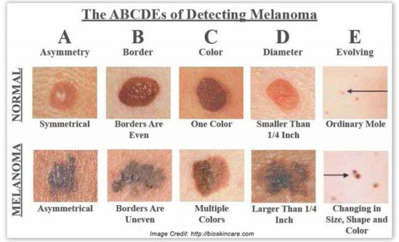 Early melanoma detection.