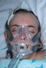 BiPAP for Acute Neurologic Disorders continued intensive care unit (ICU) populations. Ventilator-associated pneumonia is not only common, but the mortality rate is approximately 30%.
