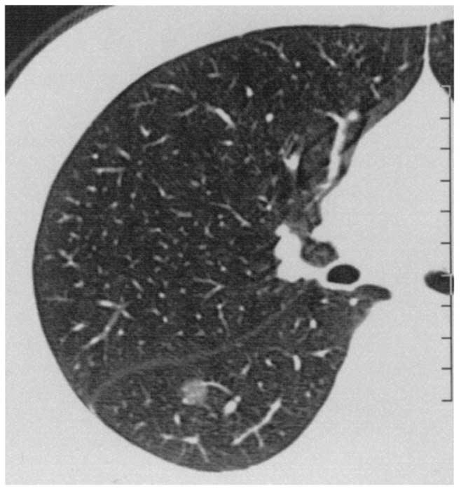Typical thin-section CT finding of focal BAC showing pure GGA appearance, in which vessels can be seen.