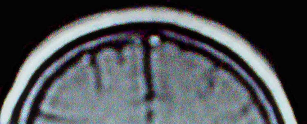 Magnetic Resonance Imaging (MRI) revealed a 20 x 13 x 15 milimeters heterogeneously enhancing