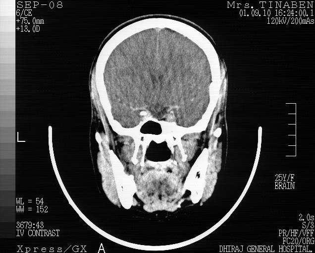 This enabled us to remove the entire tumour (though piecemeal) with decompression of the superior orbital fissure and preservation of the posterior pituitary.