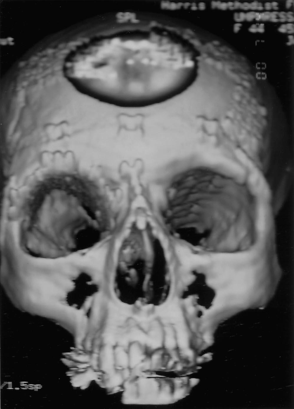 of the three-dimensional orbital contour on the patient s right side.