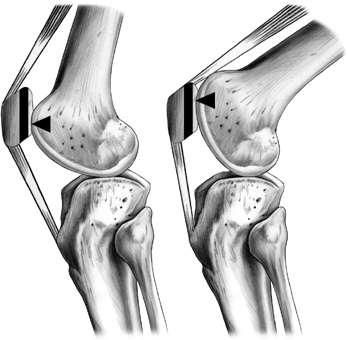 patella tendon and quadriceps tendon.