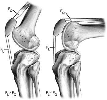 Due to changing lever arms, quadriceps force and patella tendon force also vary with knee flexion angle, with greater quadriceps force occurring at high flexion angles Patellofemoral compression