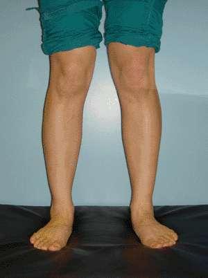 varus-valgus alignment, knee recurvatum,