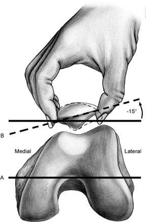 Provocative tests Patellar tilt test: inability to lift the lateral facet more than 15 degrees = tight lateral retinaculum The J