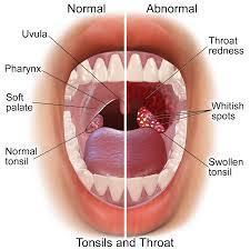 1 What Is? Tonsils are the two lymph nodes located on each side of the back of your throat. They function as a defense mechanism, helping to prevent infection from entering the rest of your body.