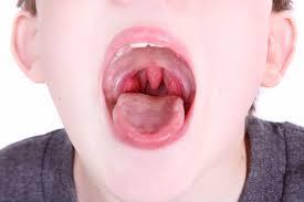 The most common include: a very sore throat difficulty swallowing or painful swallowing a scratchy-sounding voice bad breath fever chills earaches stomach aches headaches a stiff neck jaw and neck