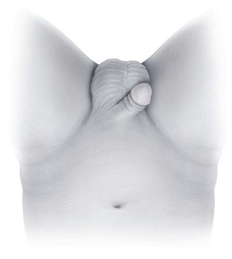 PIZZOCARO and GUARNERI SURGICAL STEPS Figure 1 A para-inguinal incision is made 2 cm above the inguinal fold from the pubic