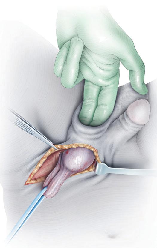 SURGERY ILLUSTRATED SURGICAL ATLAS Figure 4 The testis, covered by its tunics, is brought outside the scrotum by a