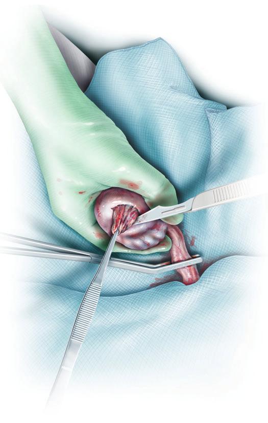 SURGERY ILLUSTRATED SURGICAL ATLAS Figure 6 If the diagnosis of testicular cancer is uncertain, the operative field is protected with surgical sponges,