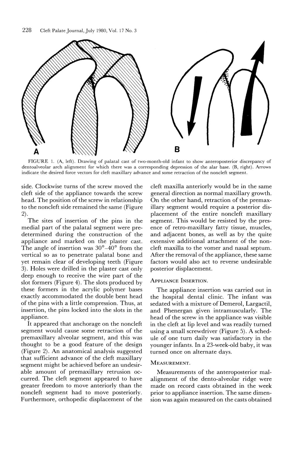 228 Cleft Palate Journal, July 1980, Vol. 17 No. 3 A FIGURE 1. (A, left).