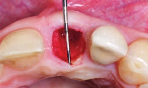 C L I N I C A L there are three different points in time when it is possible to improve the peri-implant soft tissue: at the time of tooth extraction, at implant placement or afterwards at implant