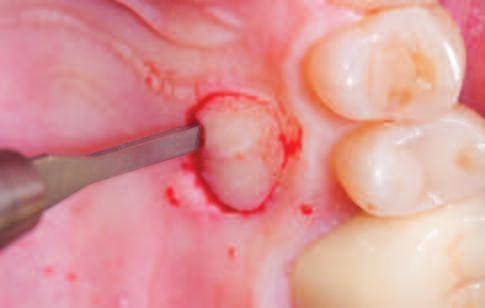 comes with two relevant disadvantages: the use of thick connective tissue grafts from the palate to cover extraction sockets cannot completely compensate for the tissue defects that