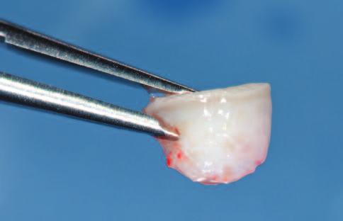 During placement If soft tissue augmentation needs to be performed in the course of implant therapy, this is often done in the same surgical intervention when the implant itself is