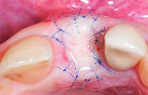 If the buccal lamella is intact and appears to have a thickness of at least 1 mm, soft tissue augmentation can be done in terms of ridge preservation in conjunction with immediate