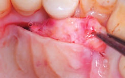 Figure 9: The graft is placed into the pouch with the help of sutures.
