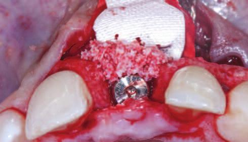 An excellent method for performing horizontal hard tissue augmentation with simultaneous Figure 10: The buccal