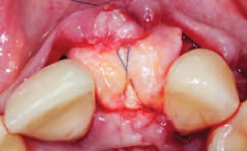 Figure 13: A soft tissue graft is used to increase tissue volume. Figure 14: Even in the case of wound dehiscence, the soft tissue graft protects the underlying membranes.