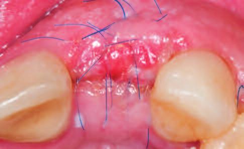 Instead of incisions close to the defect, a c- shaped incision distal to the second premolar is made.