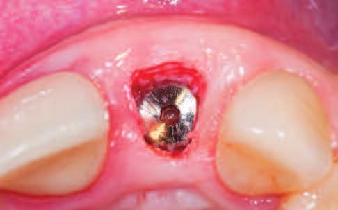Figure 15: If sufficient tissue is present, a simple individualized mucosal punch can be performed for uncoverage. Figure 16: A roll flap is used to compensate moderate defects.