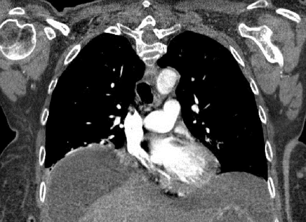 Fig. 7: Case 2: A coronal CT image shows elevated right diaphragm caused by fluid collection in the right subfphrenic