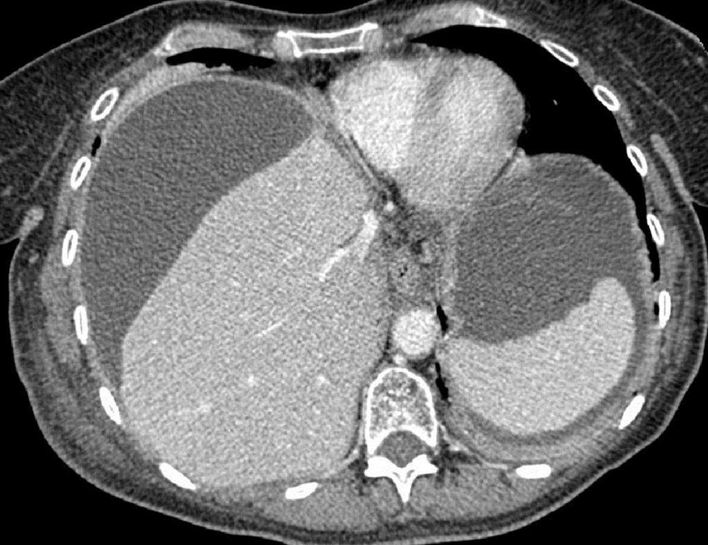 Fig. 8: Case 2: An axial CT image shows elevated right diaphragm caused by fluid collection in the right subfphrenic space and free