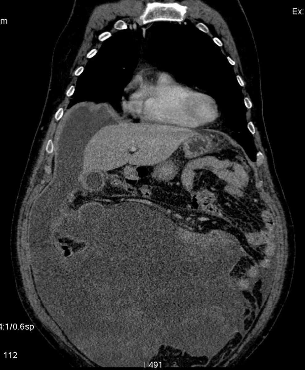 Fig. 14: Case 4: 69-year-old man with erroneous diagnosis of liver trauma contusion at other hospital, came in second treatment at our hospital.