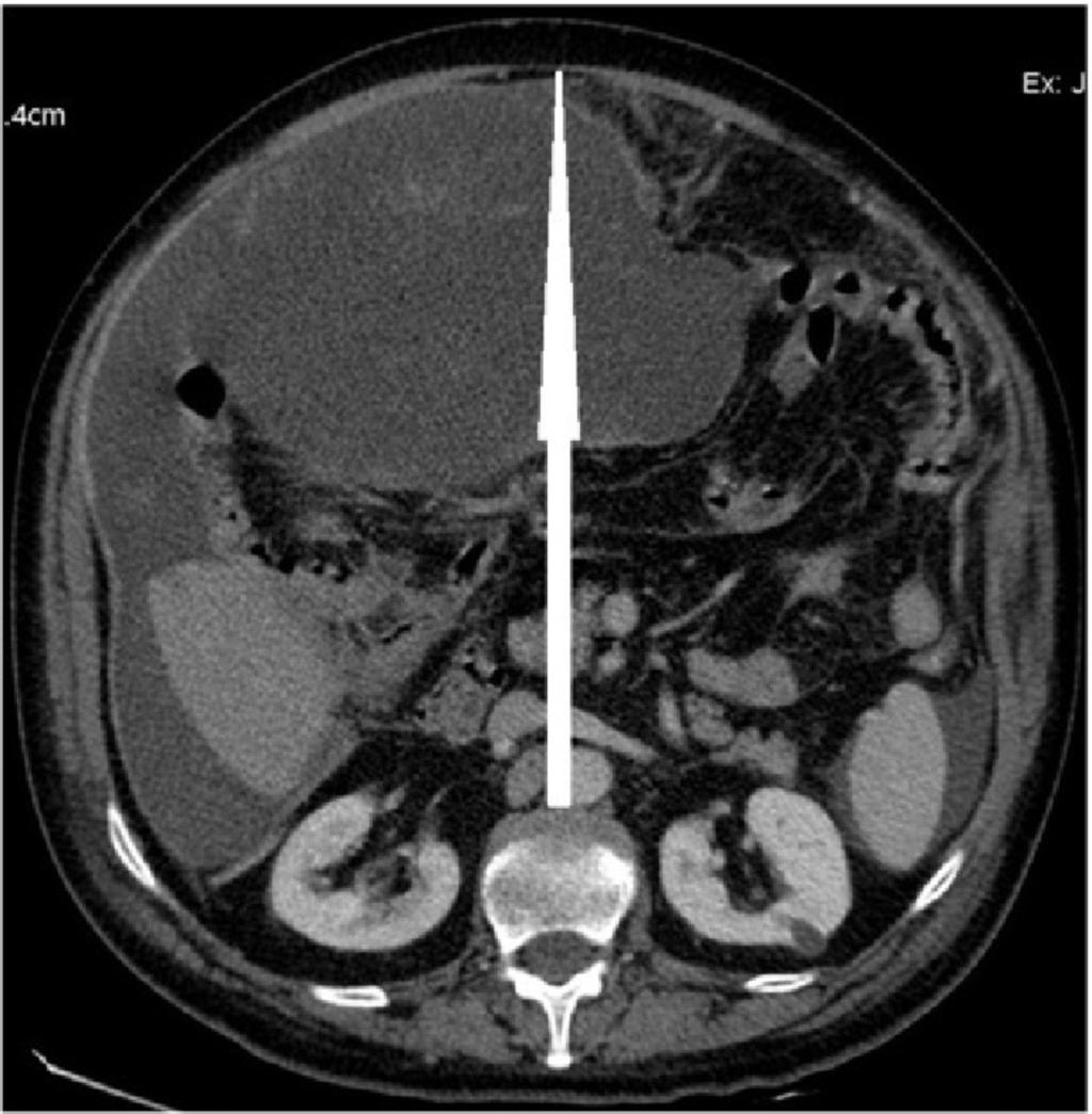 Fig. 15: Case 4: 69-year-old man with erroneous diagnosis of liver trauma contusion at other hospital, came in second treatment at our hospital.