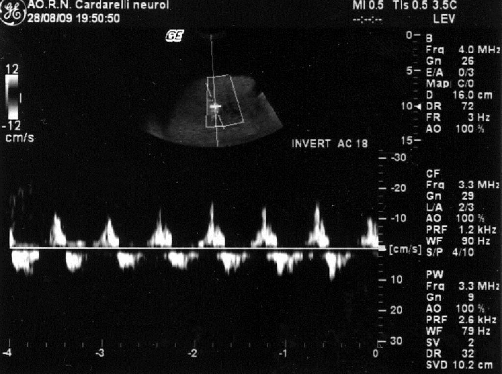 Fig. 16: Case 5: 51-year-old present dyspnea after a liver transplant. X-ray film image shows elevated left diaphragm (black arrow). Intra-vesical pressure was 21 mmhg. Fig.