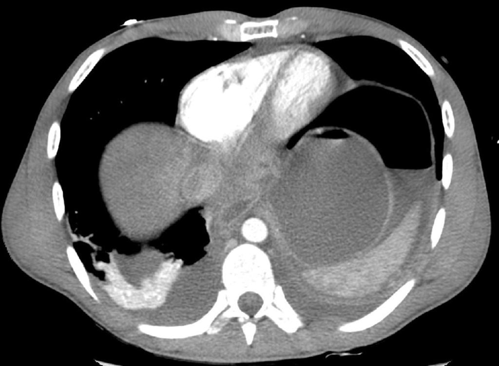 Fig. 3: Case 1: Scout CT image obtained after colectomy for sudden hypotension shows elevated left diaphragm, free endo-peritoneal air caused by ileal perforation.