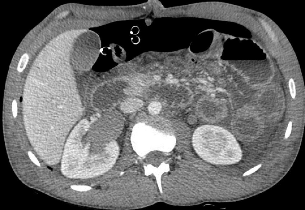 Fig. 5: Case 1: After surgery, Axial CT image shows small bowell loops mucosal hyperenhancement