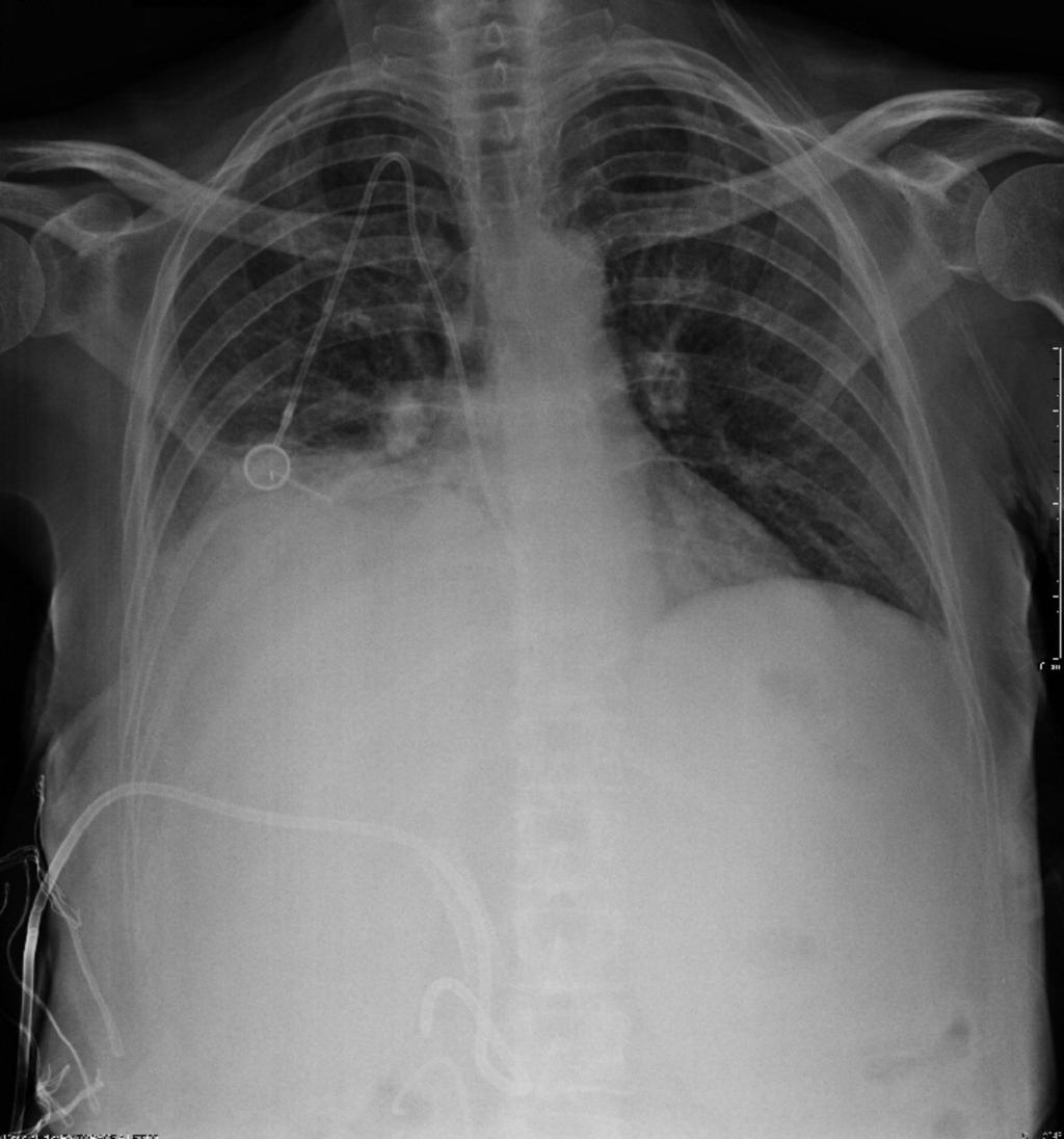 Fig. 6: Case 2: 58-year old woman after pancreatic surgery, the patient presents with sudden hypotension, dyspnea and