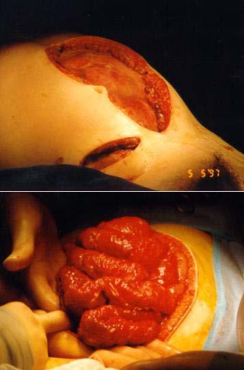 Illustrative case 14 yo boy with delayed diagnosis of appendicitis POD9 Appendectomy 2 wk after onset of symptoms POD4: return to OR for midline laparotomy and drainage of multiple