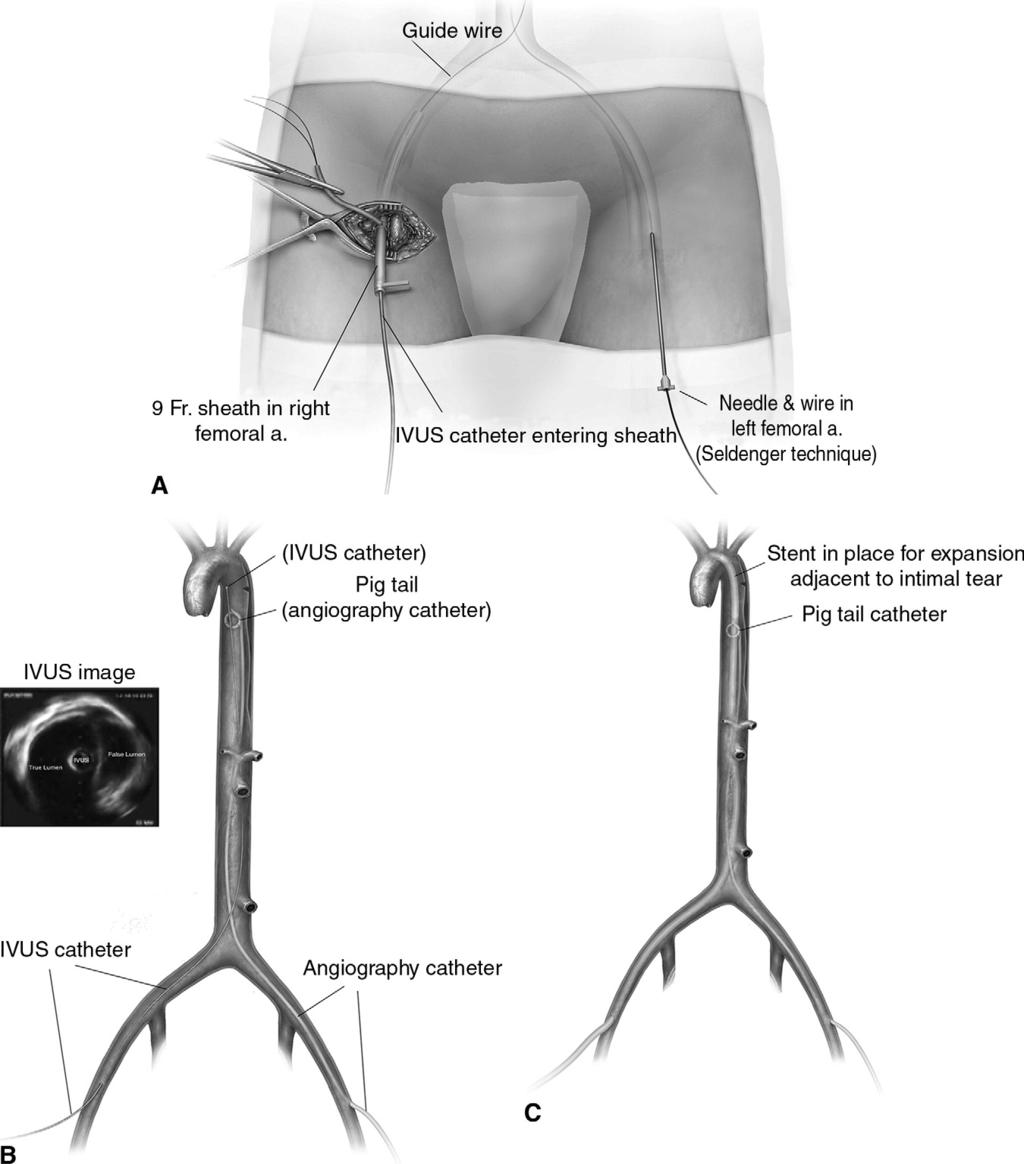 Acute descending thoracic aortic dissections 155 Figure 4 The artery is accessed with purse-string suture through which a 9-Fr. sheath is inserted over a multipurpose J-wire.