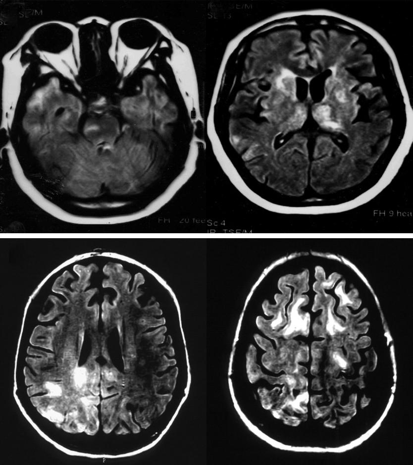 82 The Korean Journal of Internal Medicine : Vol. 22, No. 2, June 27 A B Figure 1. Representative MRI findings in a neurobehçet s disease (NBD) patient and a neuropsychiatric SLE (NPSLE) patient.