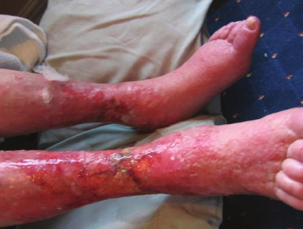 CASE 3: HIGH-EXUDING VENOUS LEG ULCER TO THE ANTERIOR SHIN Author: Rosie Callaghan, Tissue Viability Specialist Nurse in Nursing Homes, Worcestershire PCT, UK INTRODUCTION A 74-year-old female