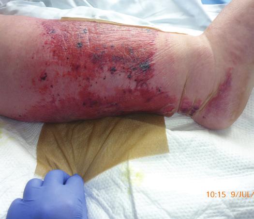 The condition of the patient s skin at initial review was poor. The lower leg was red, macerated and there were non-blanching erythema and multiple blisters that appeared full and likely to burst.