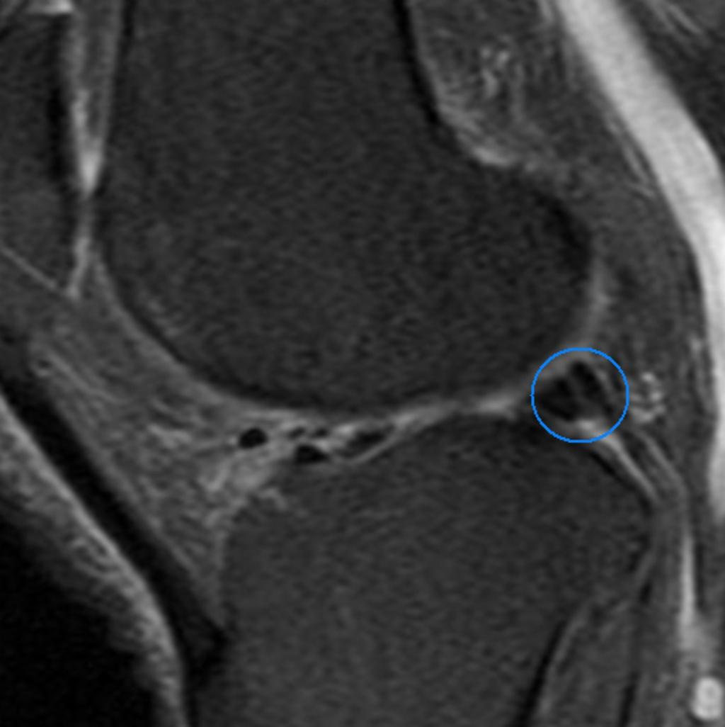 Fig.: Popliteus tendon mimicking a vertical tear in the posterior horn of the lateral meniscus (sagittal fat-saturated T2-weighted image).