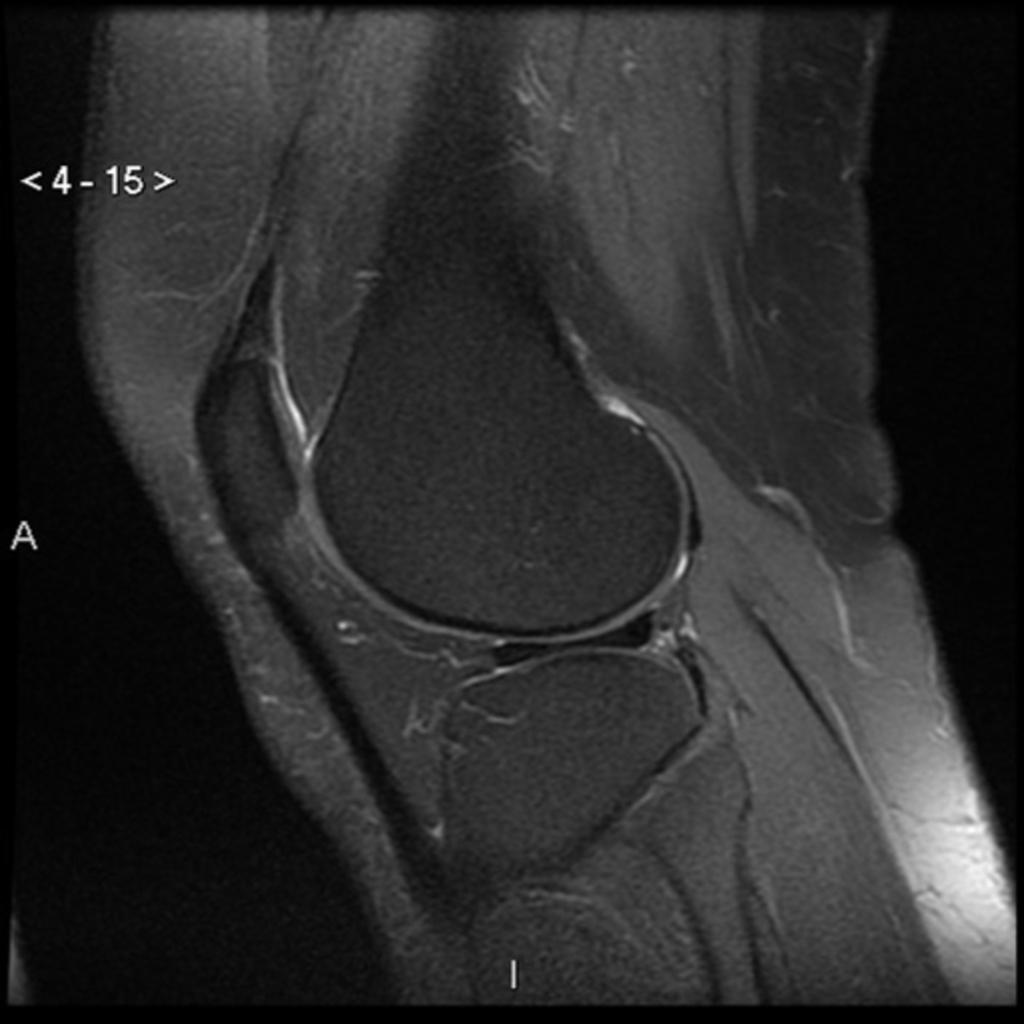 Fig.: Discoid lateral meniscus (sagittal fat-saturated T2-weighted image). Meniscal ossicles Meniscal ossicles are small ossified foci found typically in the posterior horn of the medial meniscus.