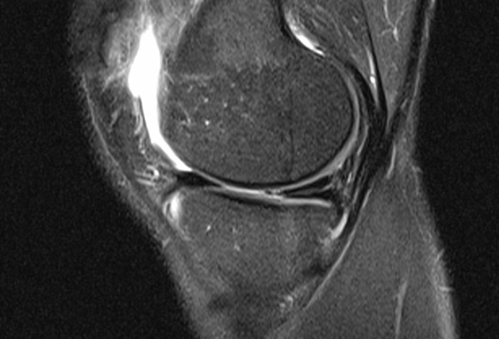 Fig.: Oblique horizontal tear of the posterior horn of the MM
