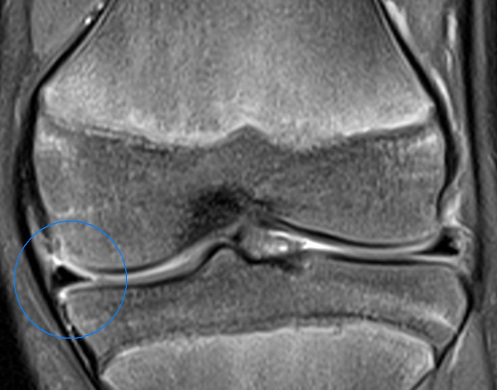Fig.: Peripheral meniscal vascularization in a child