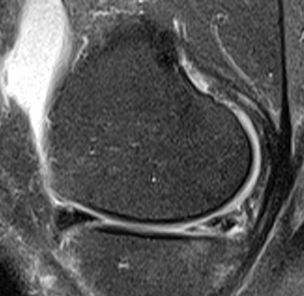 Fig.: Complex tear of the posterior horn of the medial meniscus