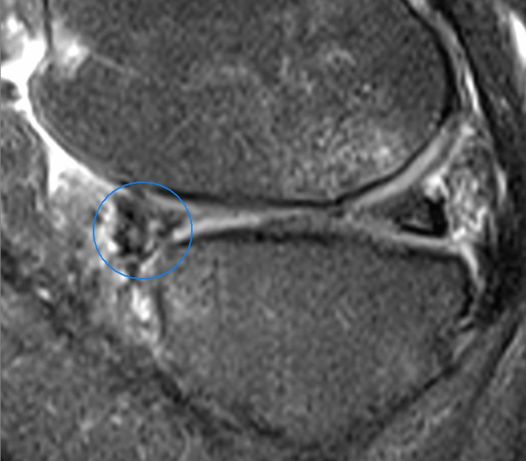 Fig.: Complex tear of the anterior horn of the medial meniscus with degenerative associated aspects (sagittal fat-saturated proton density-weighted image).