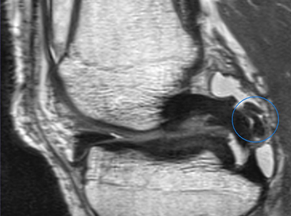 Fig.: Bucket-handle tear - the meniscal fragment is displaced posteriorly and